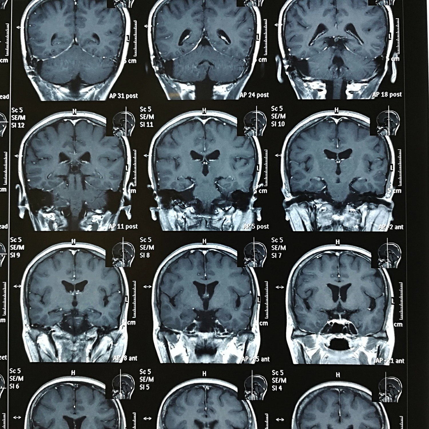 贺晓生教授听神经瘤切除手术中的面听神经保护