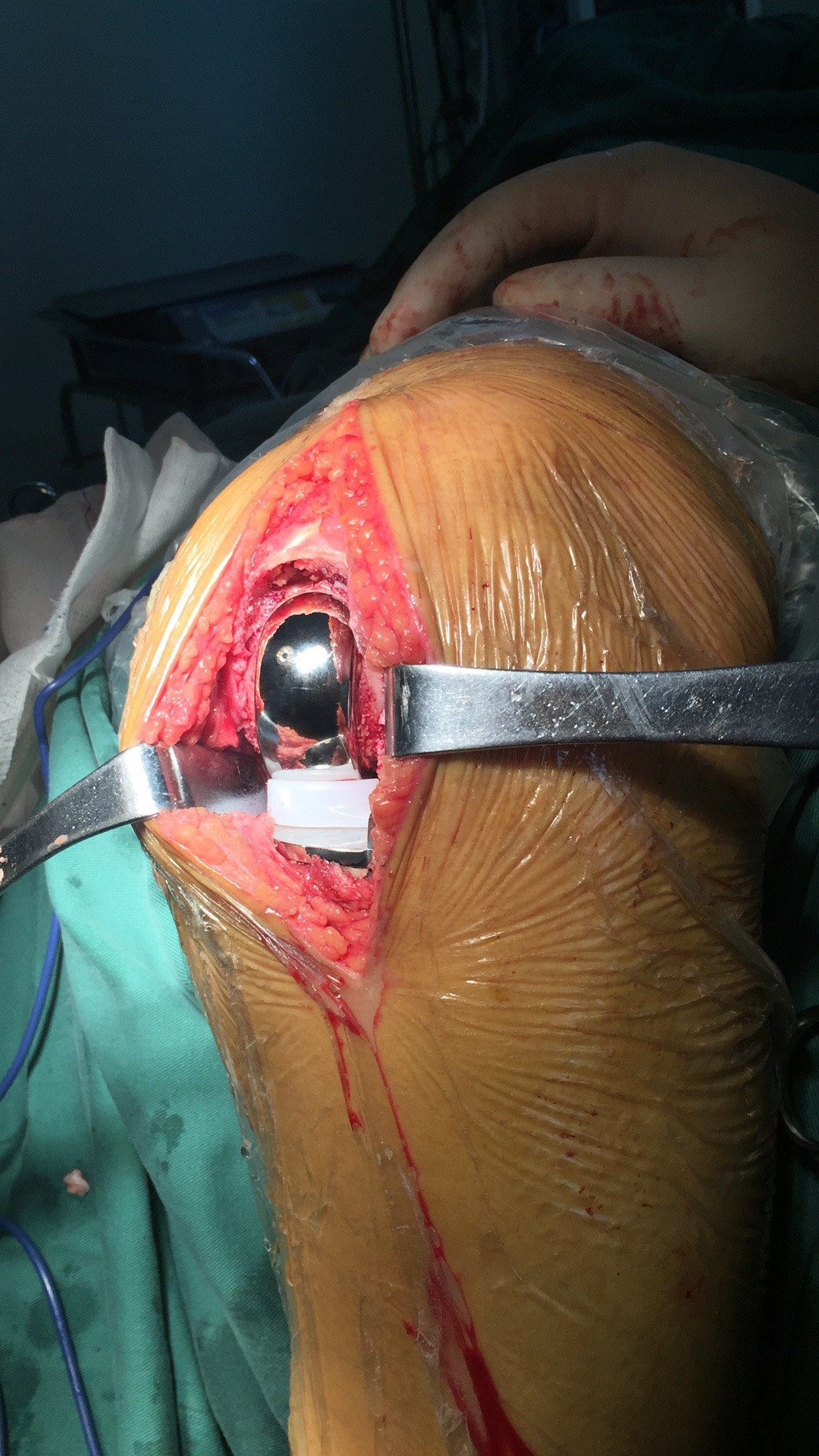 膝关节特发性骨坏死,微创单髁关节置换术. - 好大夫在线