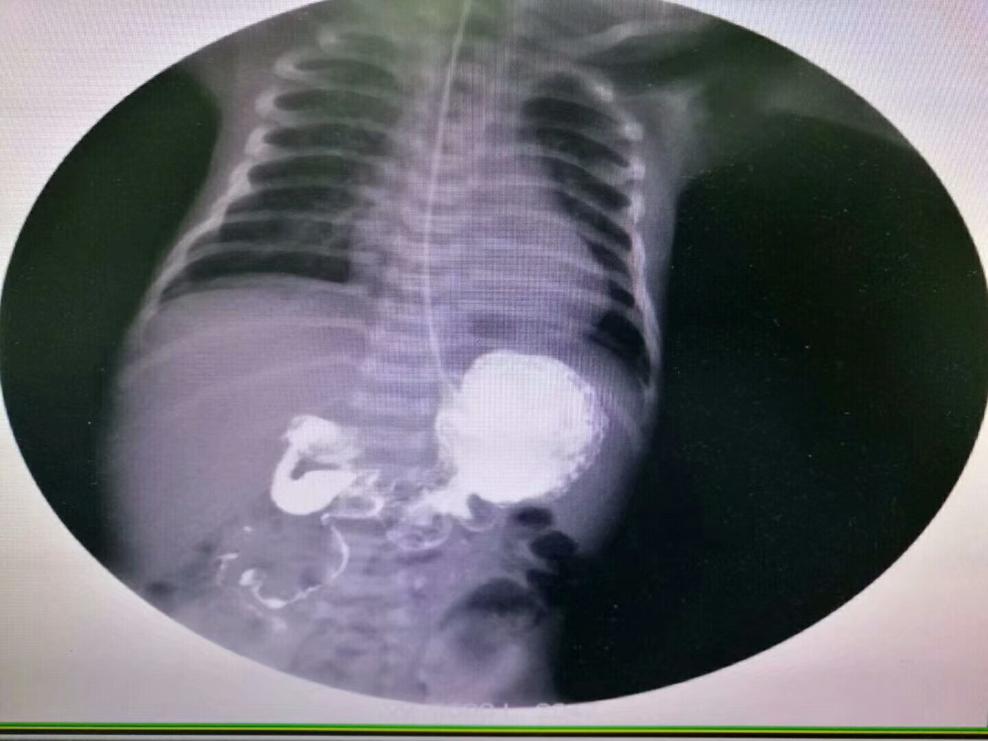 病例记录:新生儿肠旋转不良 - 好大夫在线