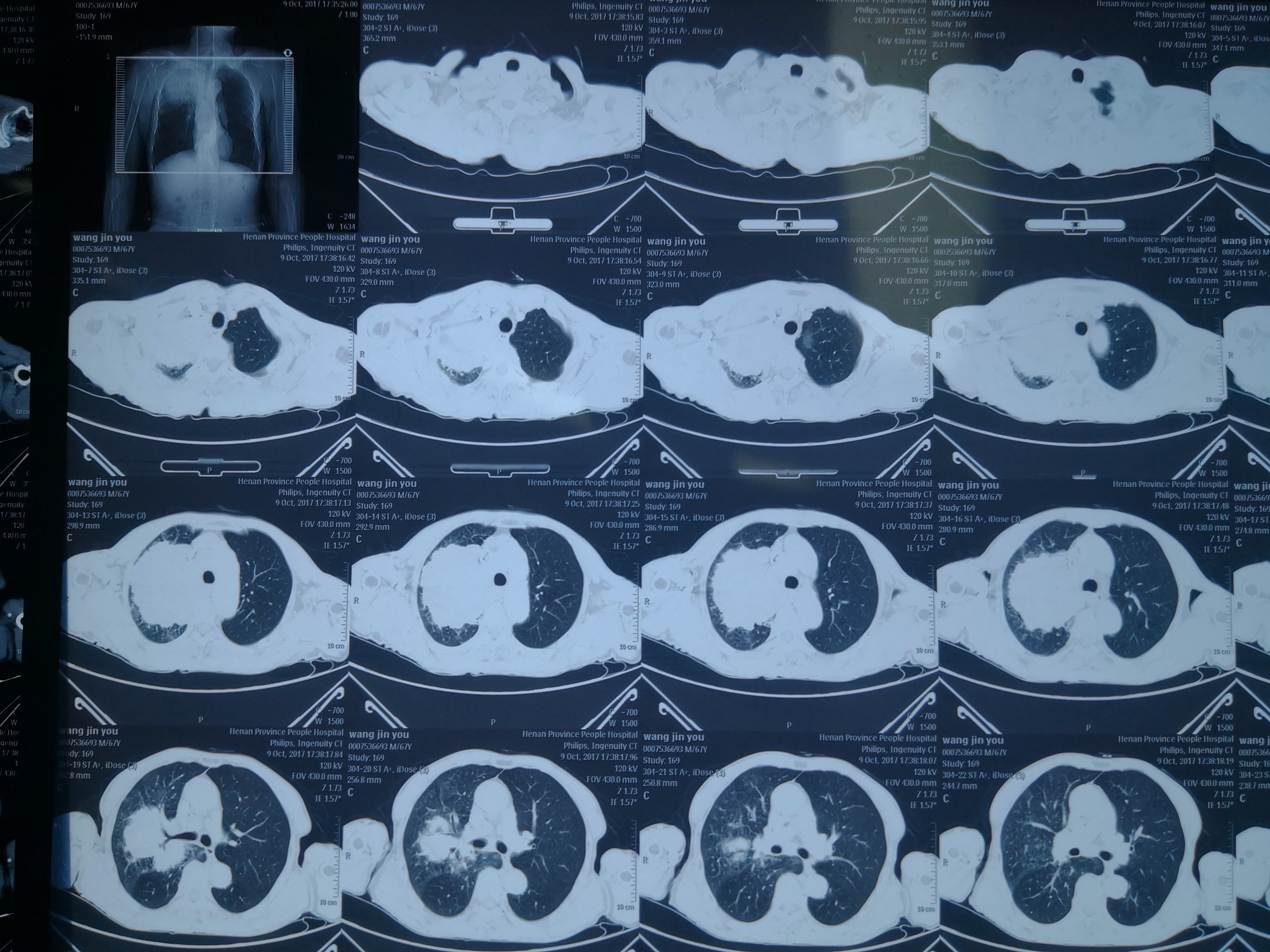 晚期右上肺癌,化疗三个周期肿瘤降期,行胸腔镜辅助右上 - 好大夫在线
