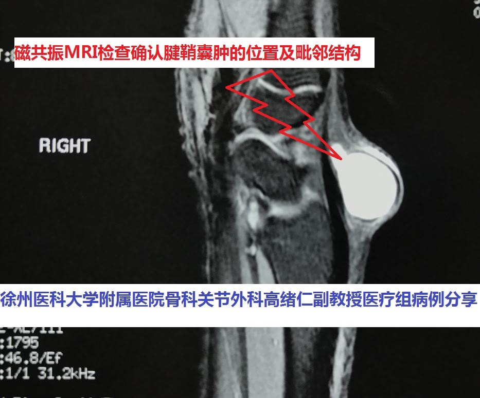 腕关节包块腱鞘囊肿怎么治疗?一定要手术切除