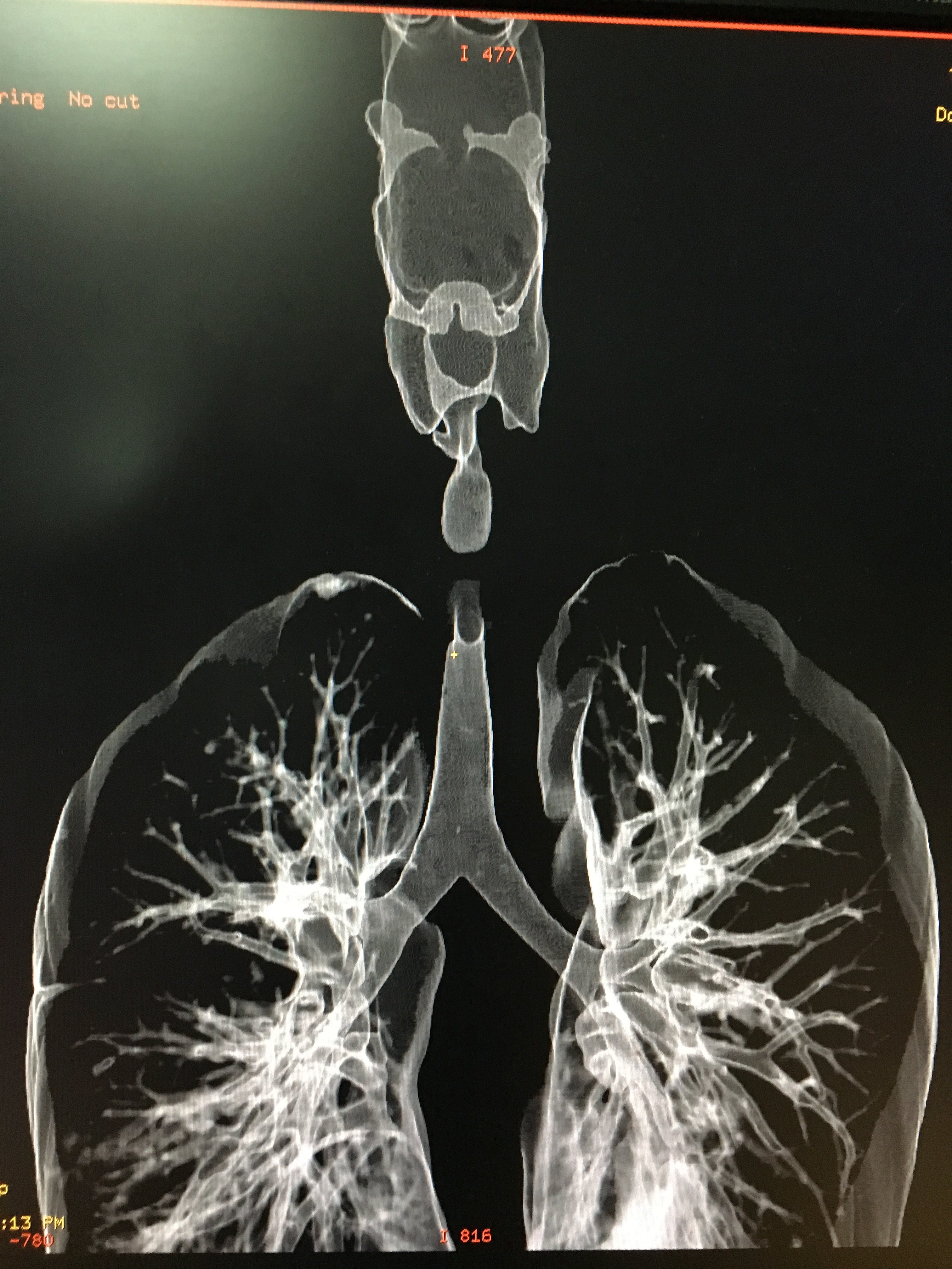 气管狭窄的三维重建 - 好大夫在线