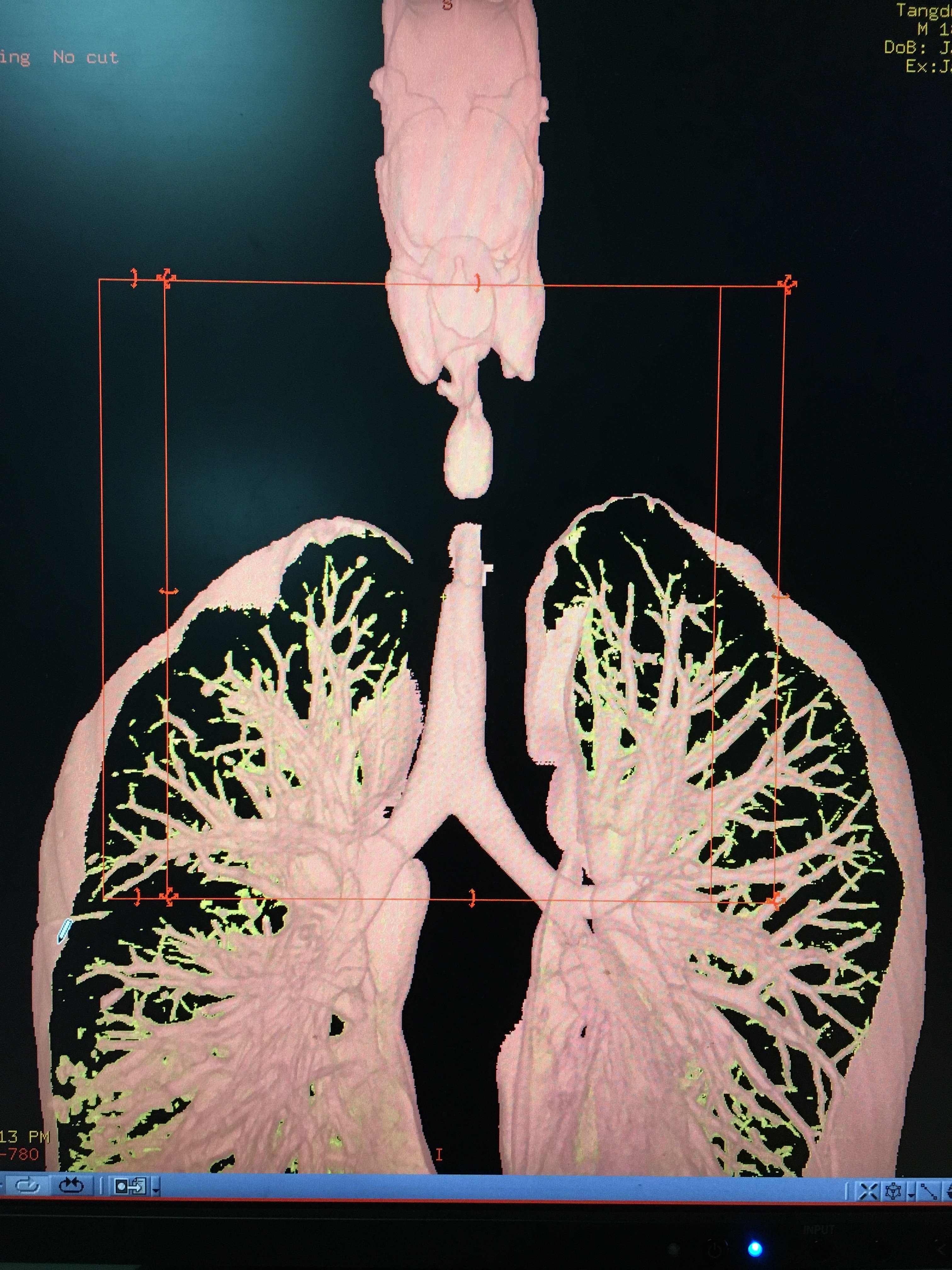 气管狭窄的三维重建 - 好大夫在线