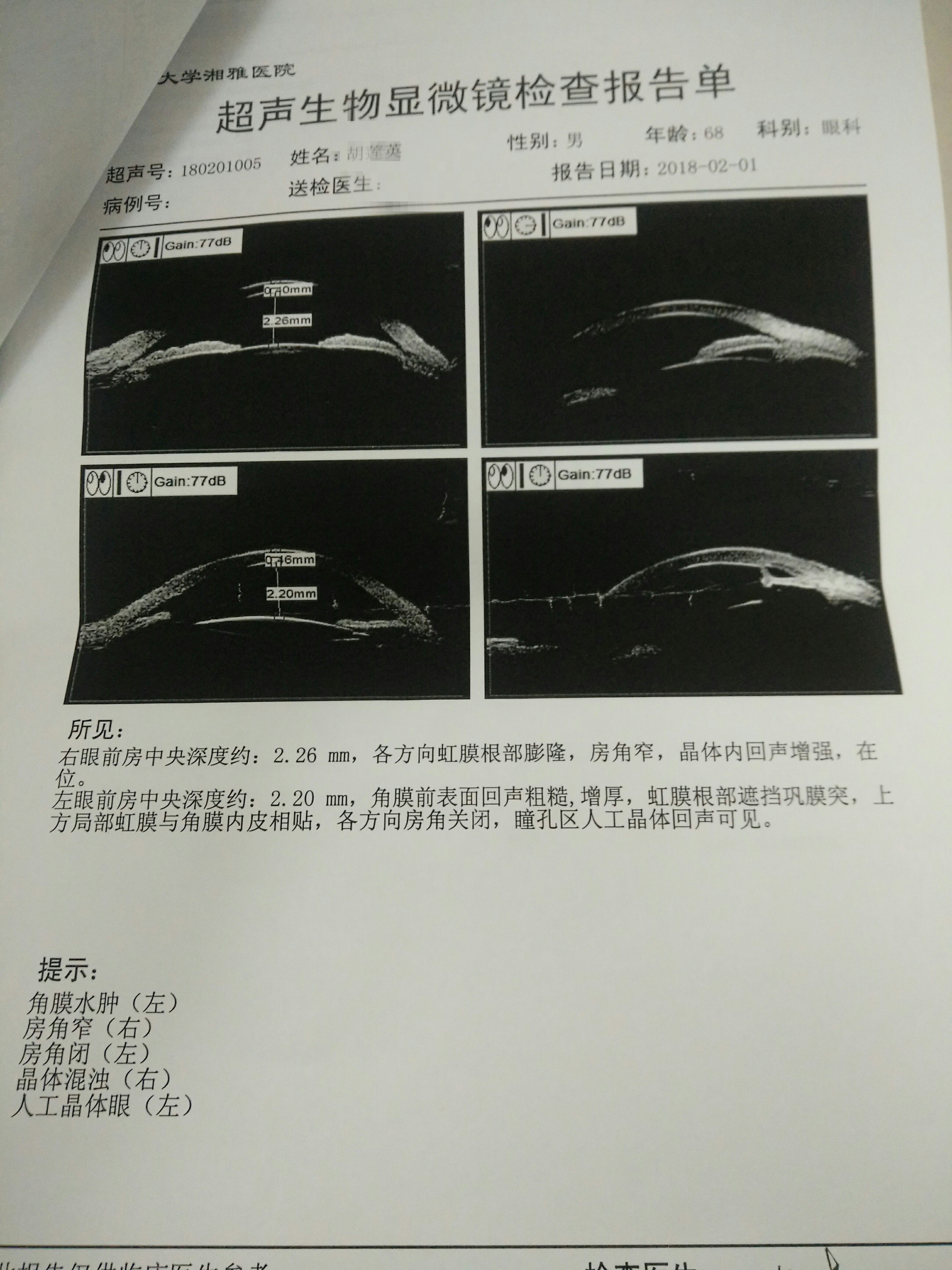 右眼视神经oct分析.双眼视网膜黄斑部oct.