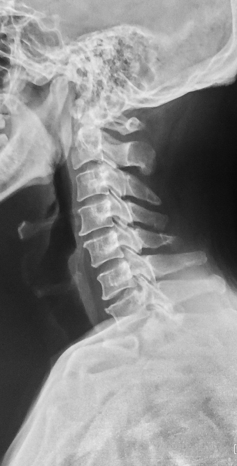颈椎后纵韧带骨化症