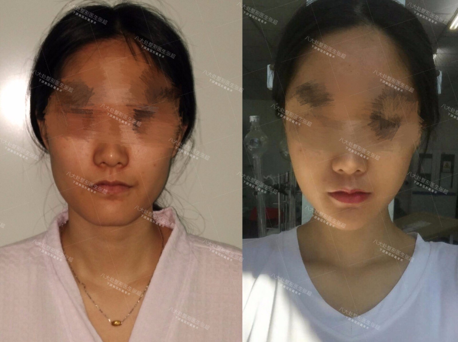 个性化下颌角弧形截骨术