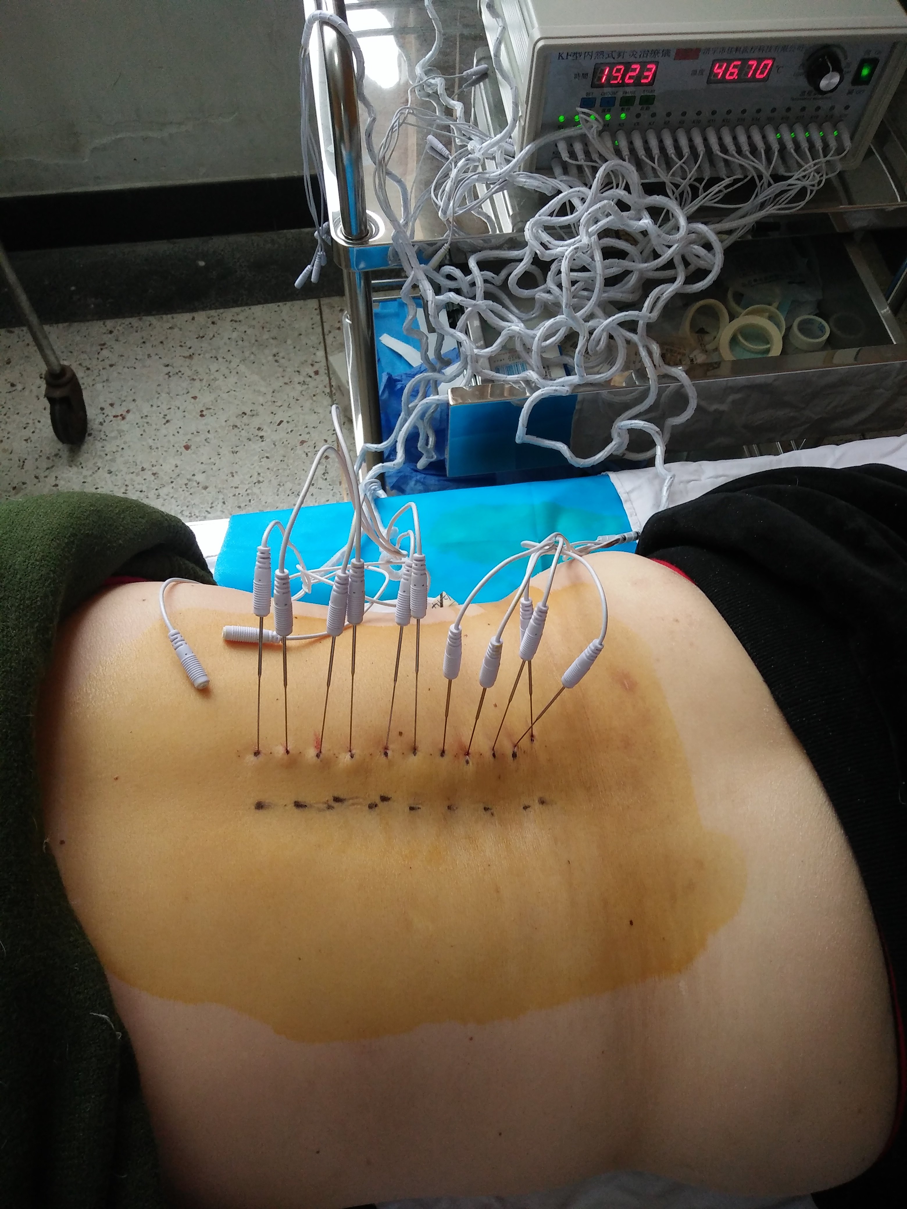 带状疱疹治疗病例 - 好大夫在线