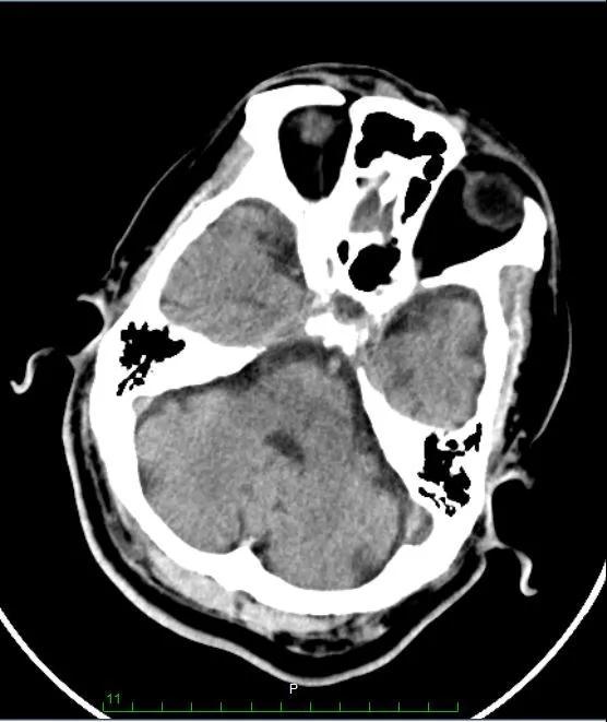 头颅ct提示1,右侧半卵圆中心,双侧放射冠