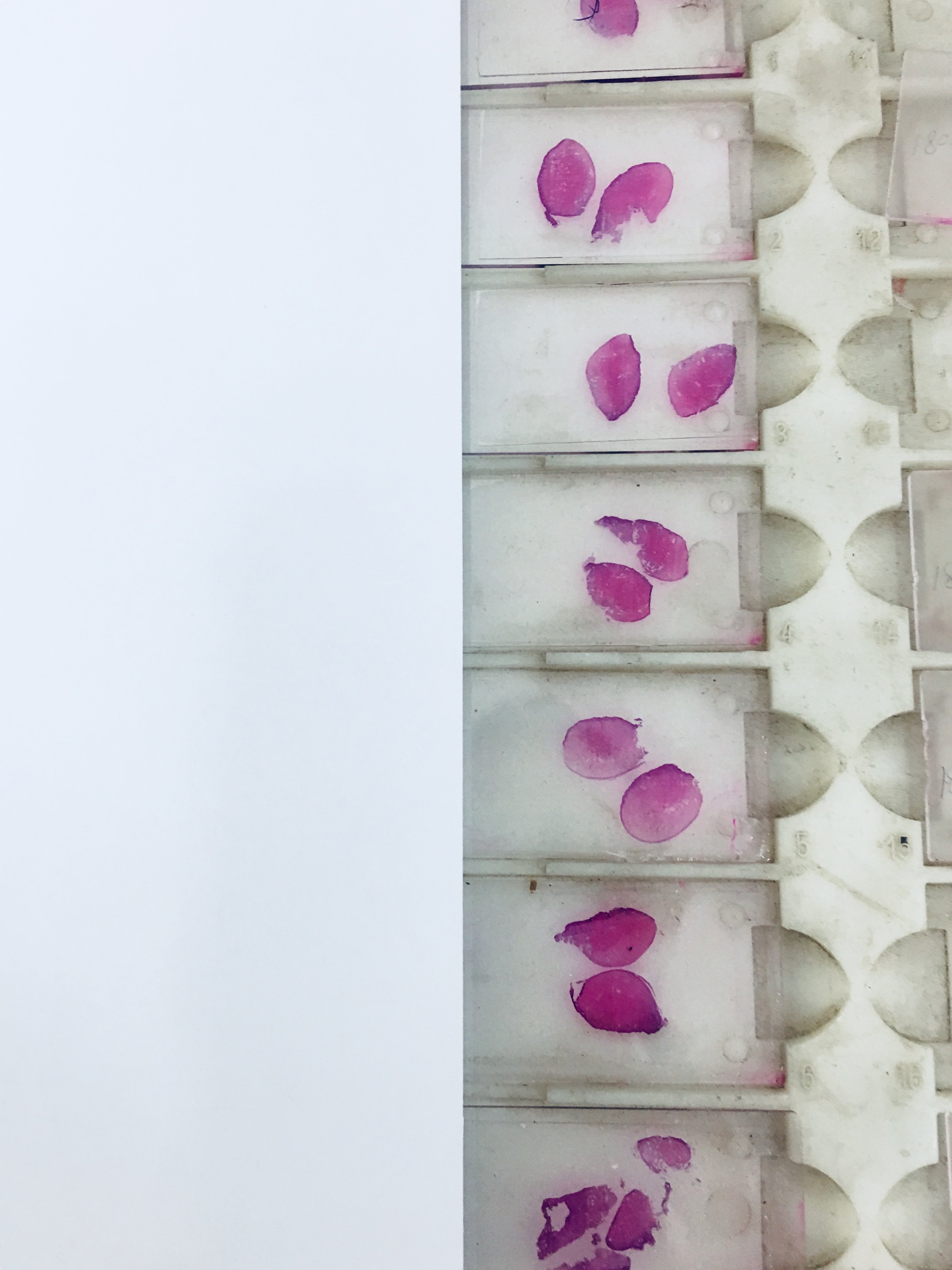 标本多 技术员可以2个组织块捞片在同一玻璃片上最后一步,病理医师阅