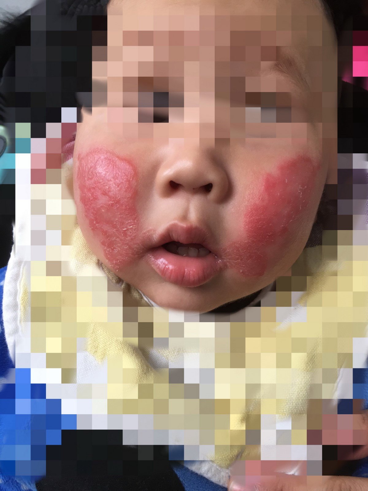 婴儿湿疹是一种常见的情况,图中的阿姨是因为前几日用了新买的某化妆