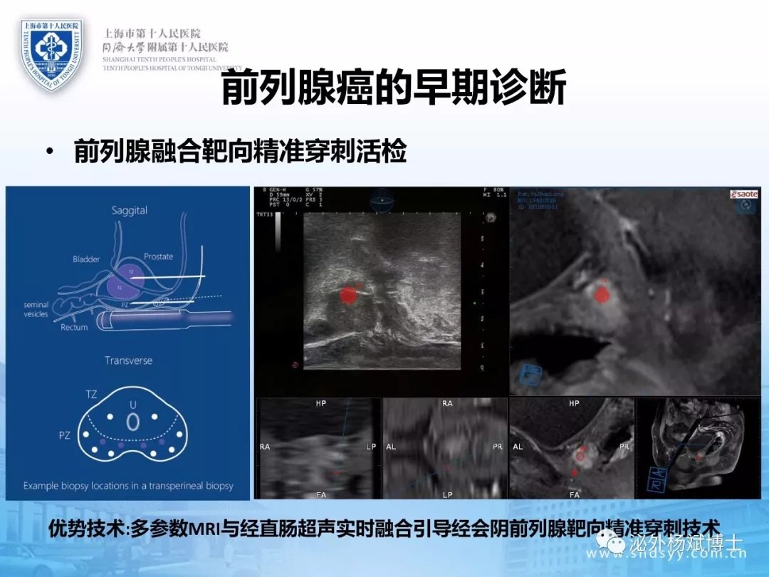 前列腺癌诊治:2017年工作总结以及2018年工作