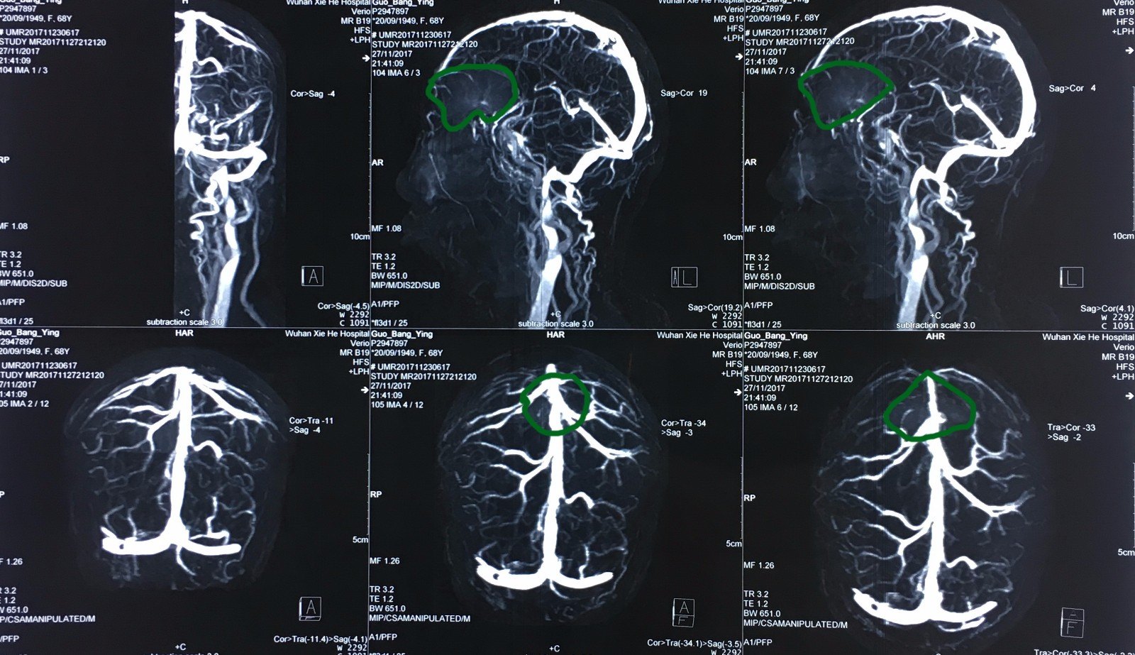 术前的核磁共振动脉造影,显示大脑前动脉及其分支被肿瘤向后及上方