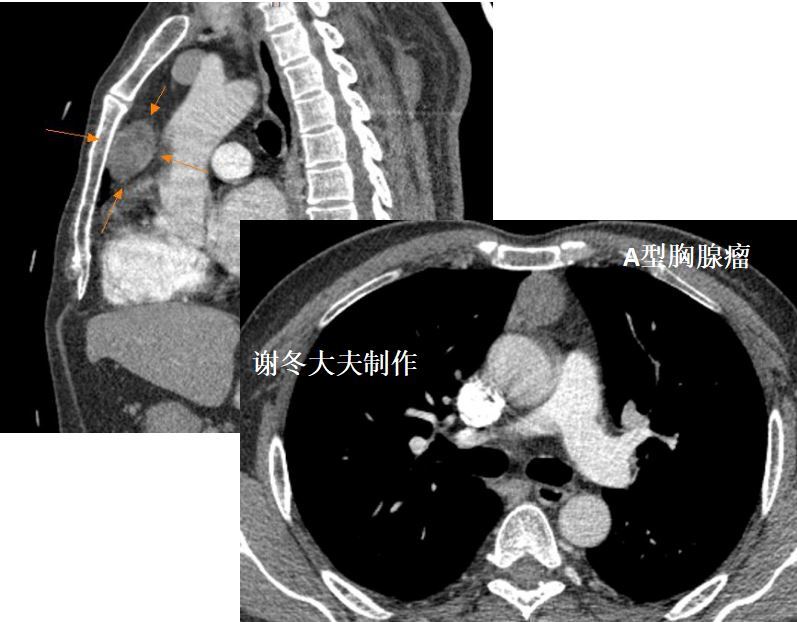 胸腺瘤是癌症吗胸腺瘤分型有哪些症状胸腺瘤怎样治疗是恶性吗纵隔肿瘤