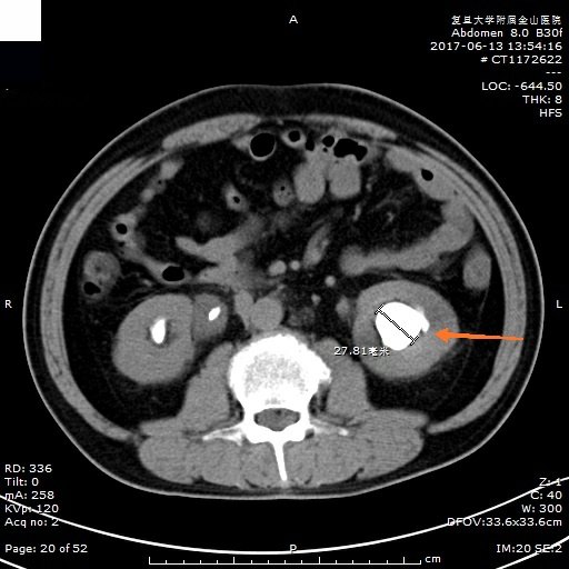 泌尿系統結石之腎結石ct表現 - 好大夫在線
