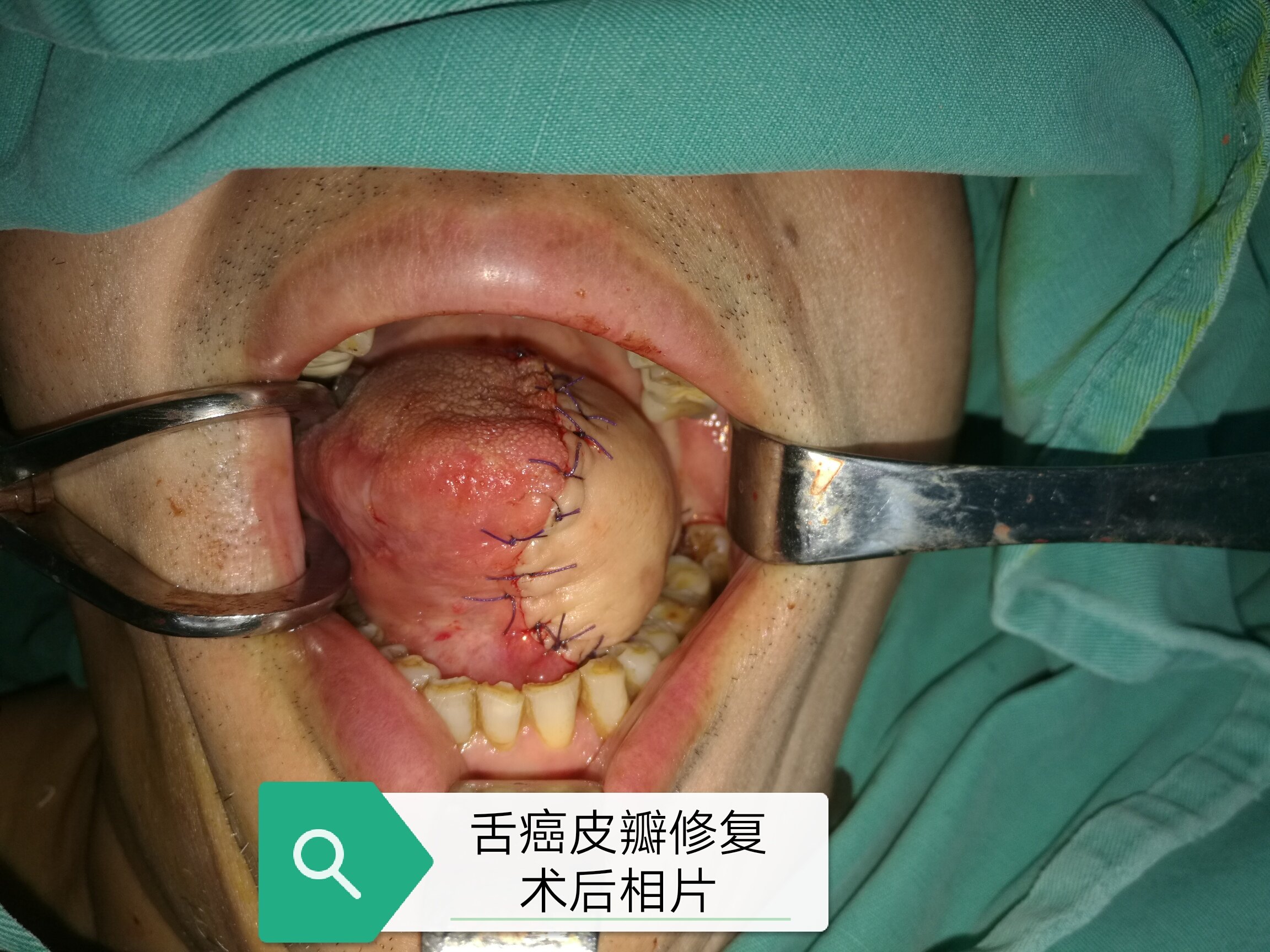 舌癌术后图片