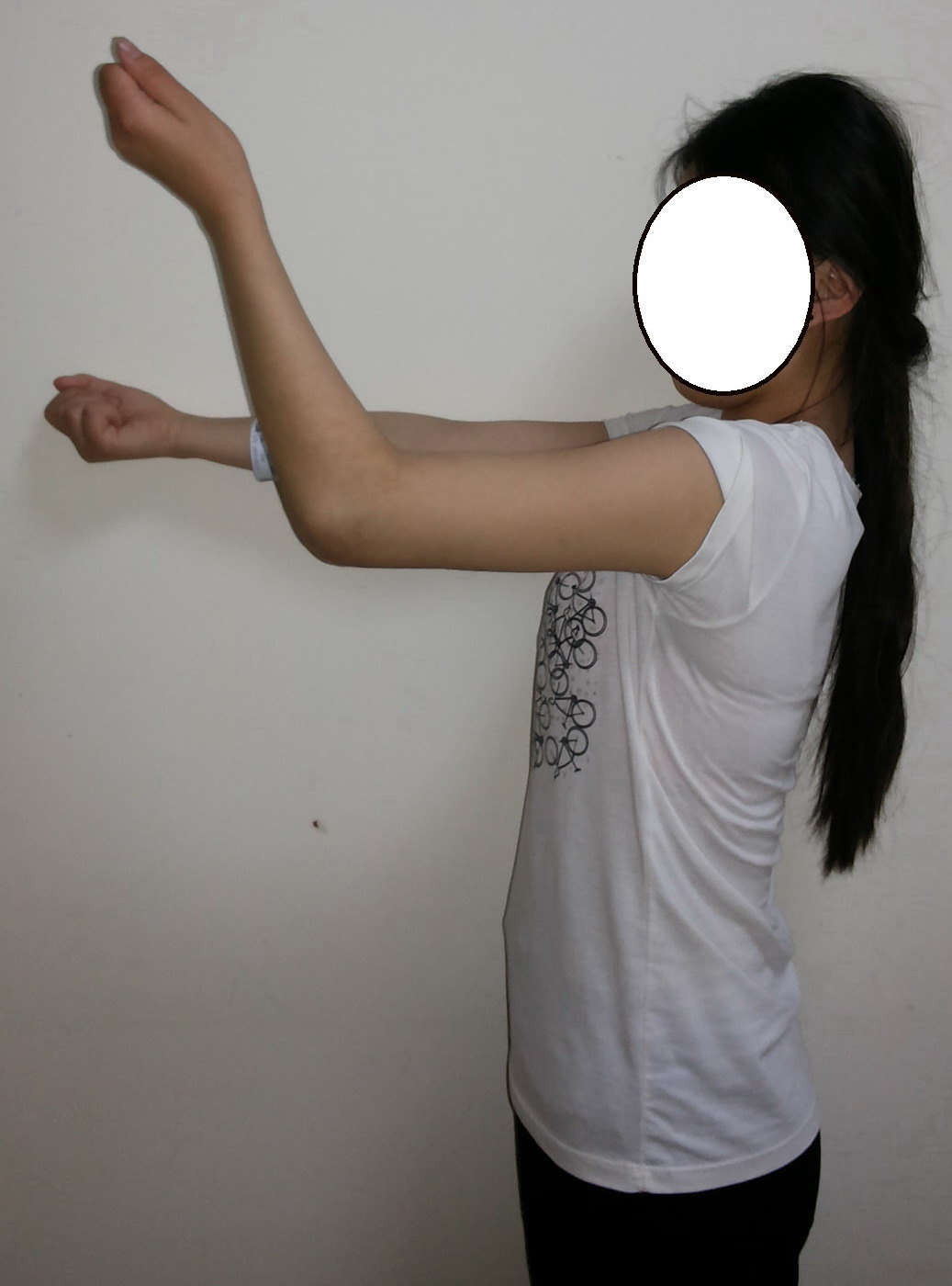 创伤 骨折 手术后肘关节僵硬的手术治疗 好大夫在线 创伤 骨折 手术后肘关节僵硬的手术治疗 好大夫在线