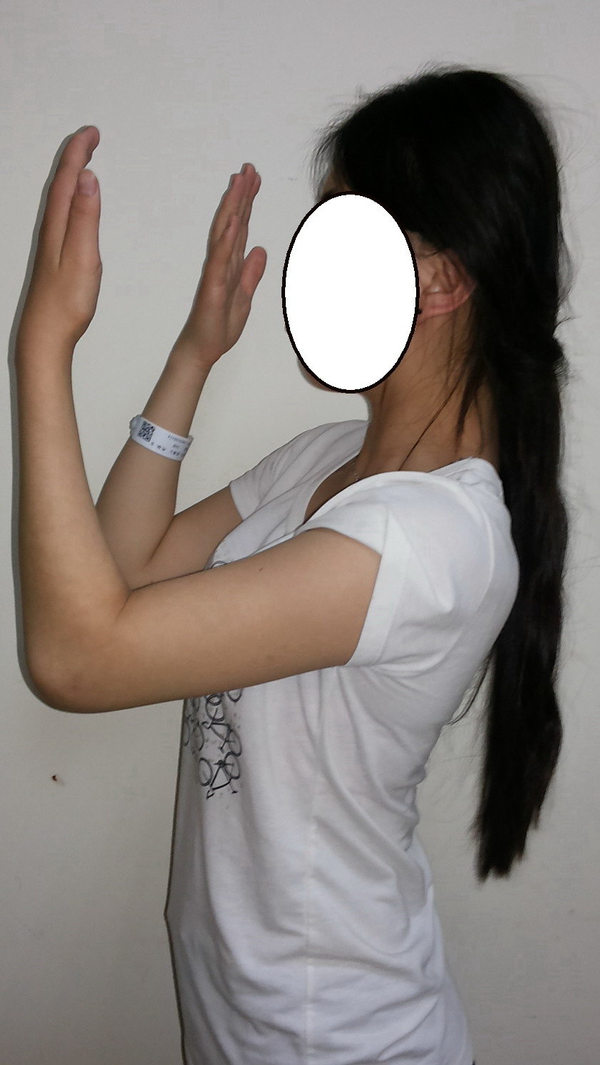 亲爱的患者朋友,当您的上肢受伤后,骨折手术后,如果不幸您的肘关节不