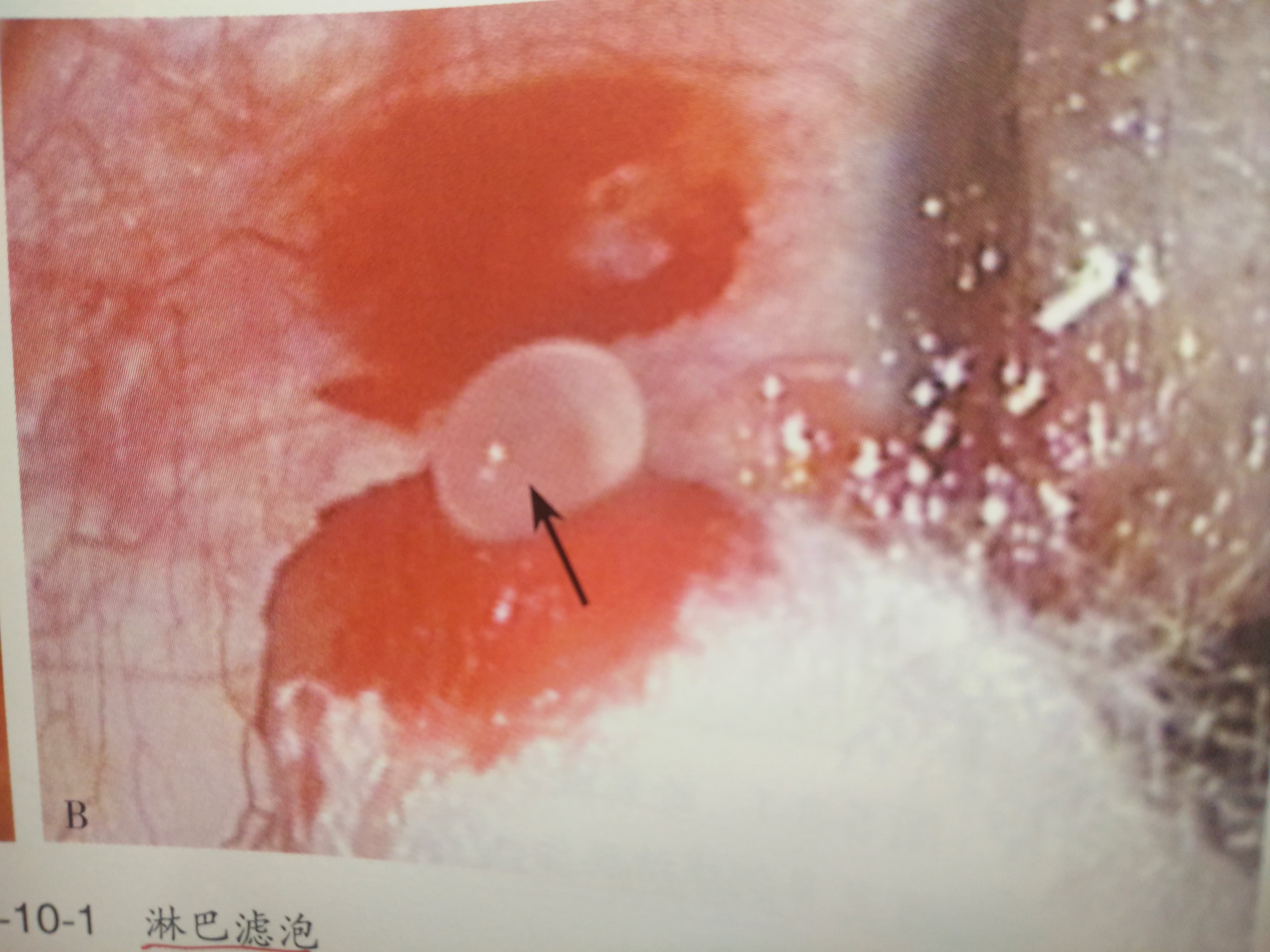 结膜滤泡症图片