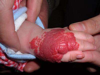 婴儿血管瘤_血管瘤_疾病介绍_治疗方法_介绍_治疗方式 - 好大夫在线