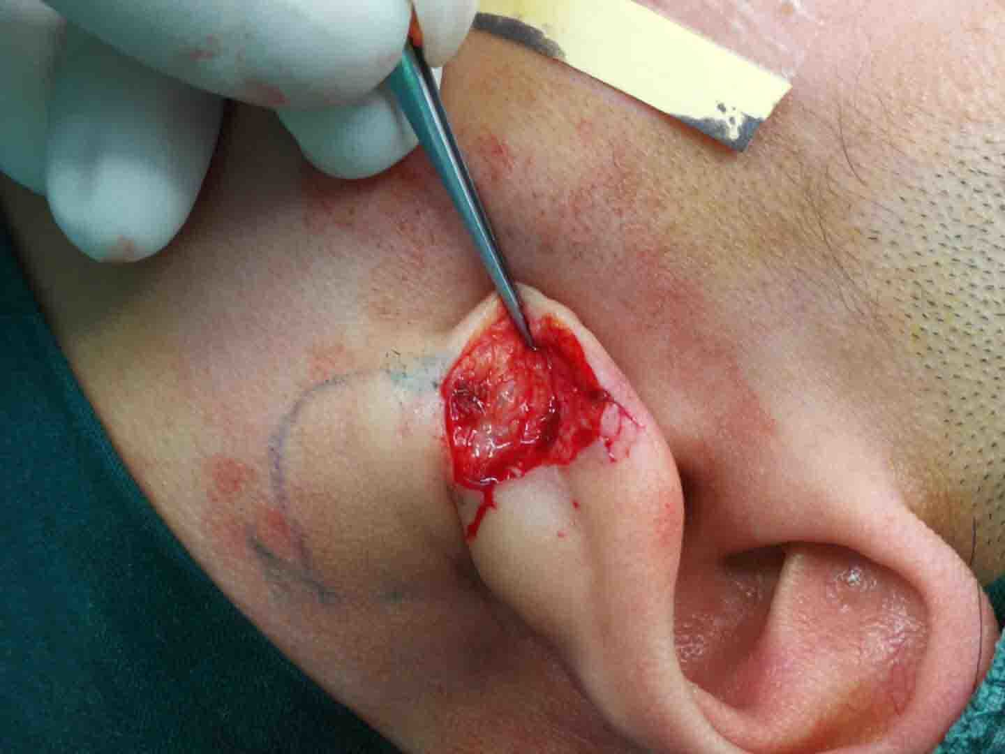 耳垂瘢痕疙瘩的治疗