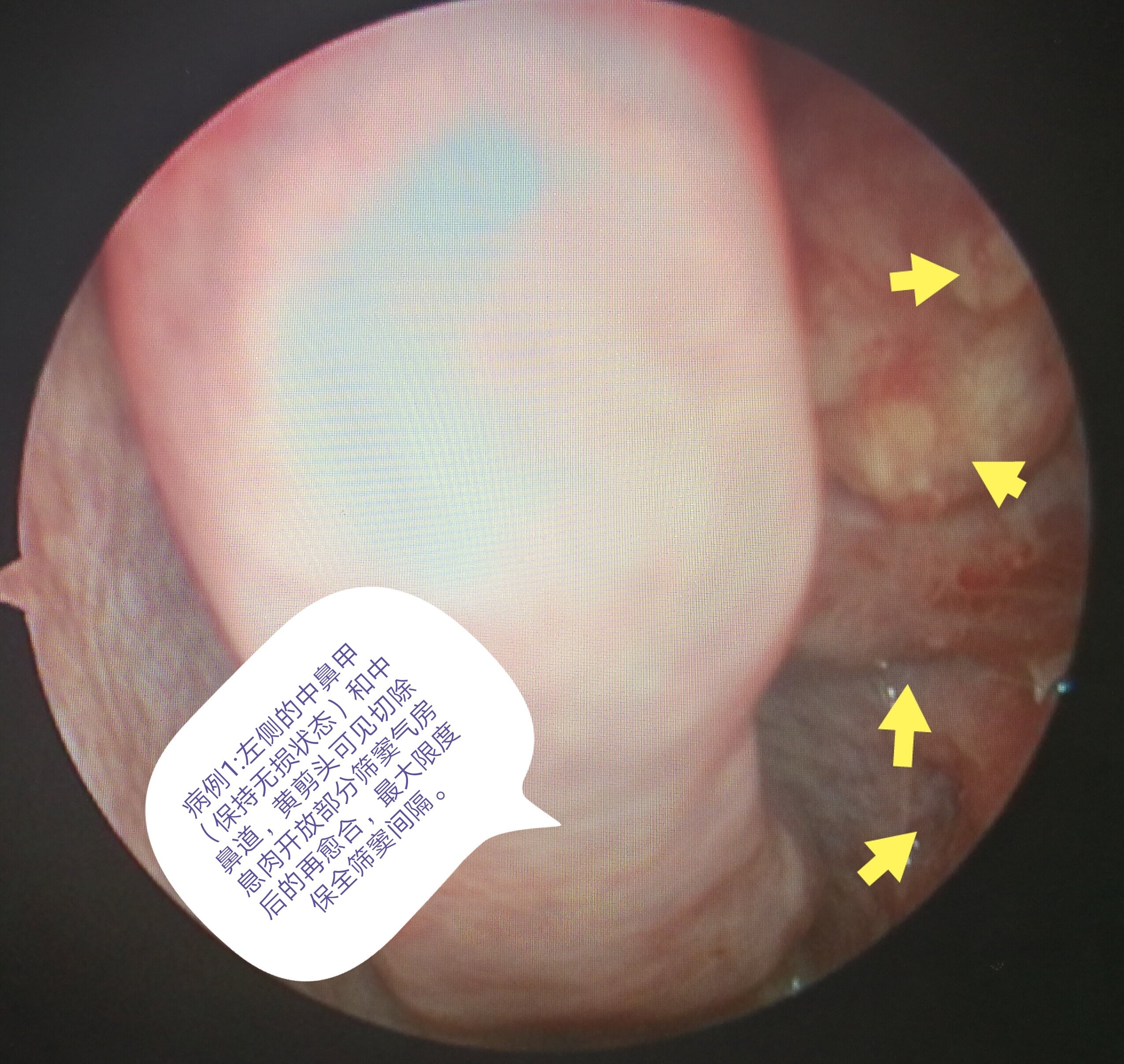 《恰当的鼻科手术不会继发空鼻症》