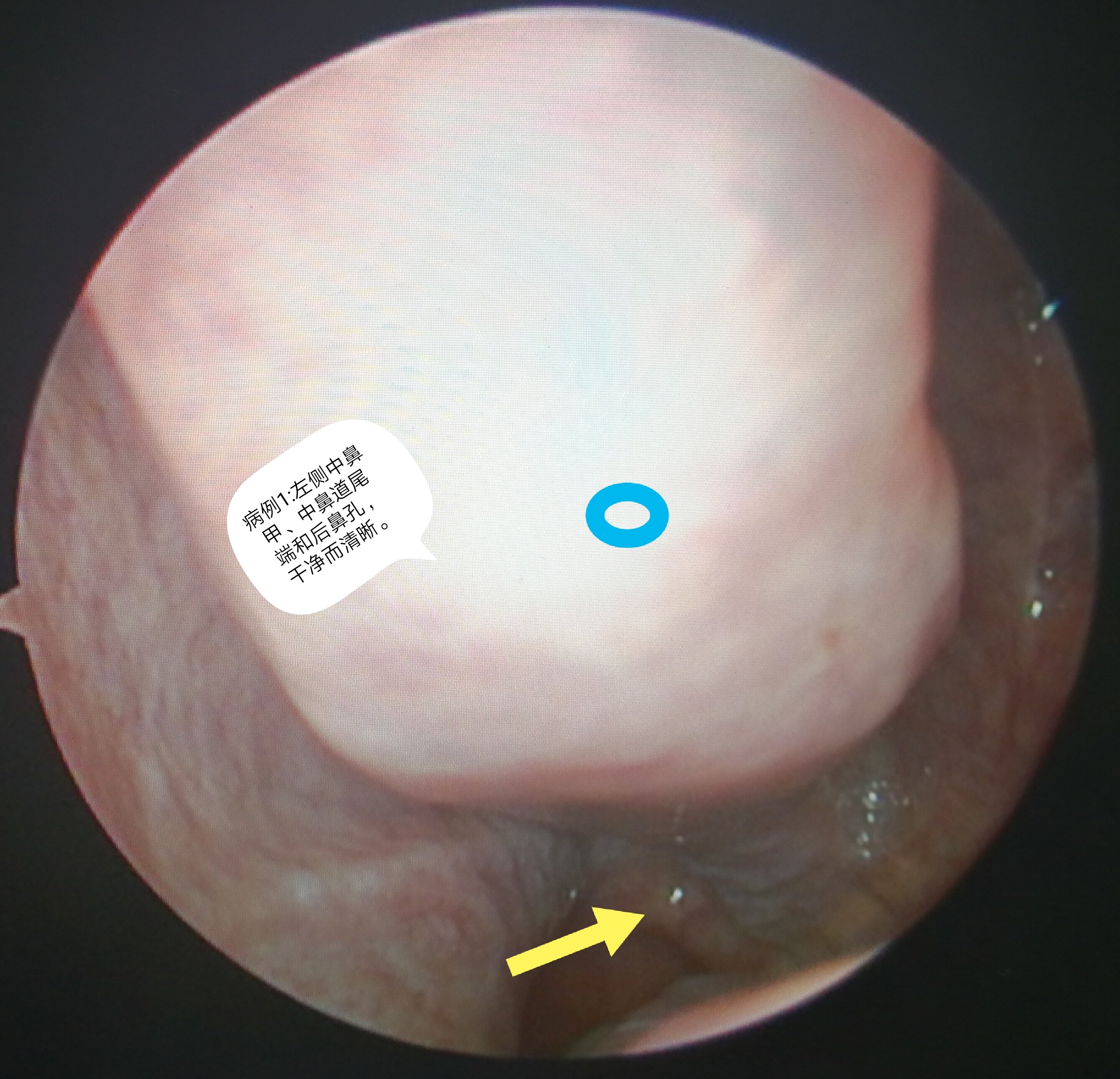 《恰当的鼻科手术不会继发空鼻症》
