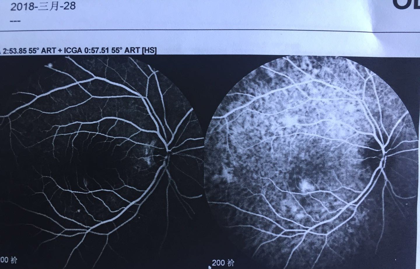 脉络膜渗漏图片