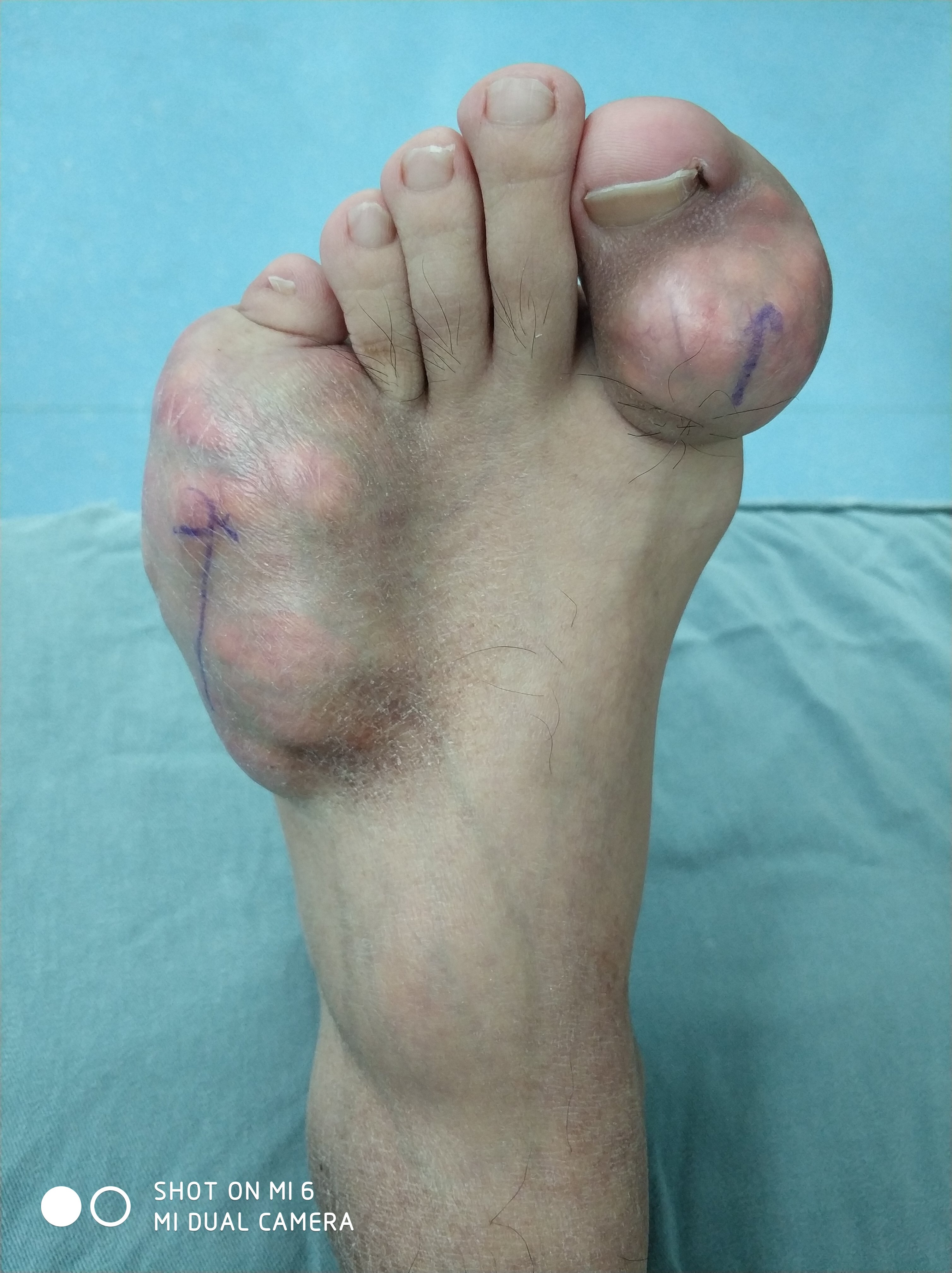 大吃大喝的代价-痛风 - 好大夫在线