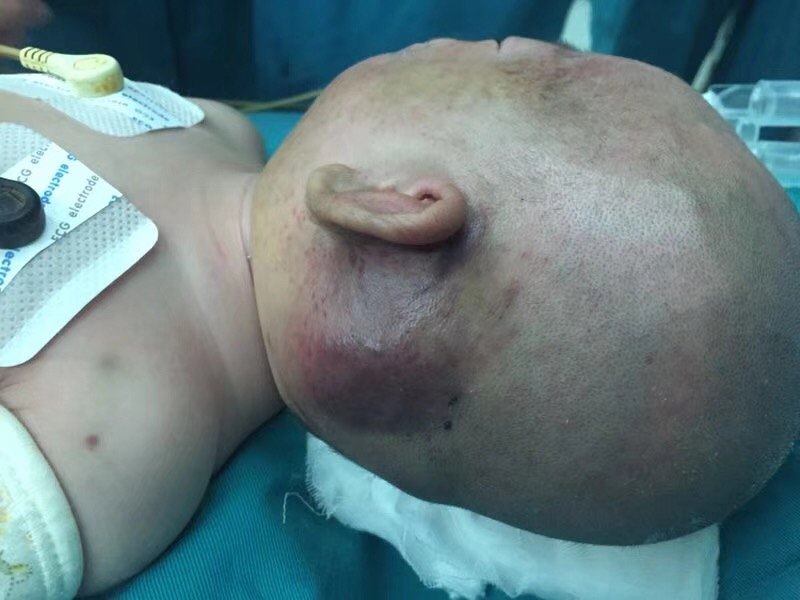 卡梅综合征手术治疗