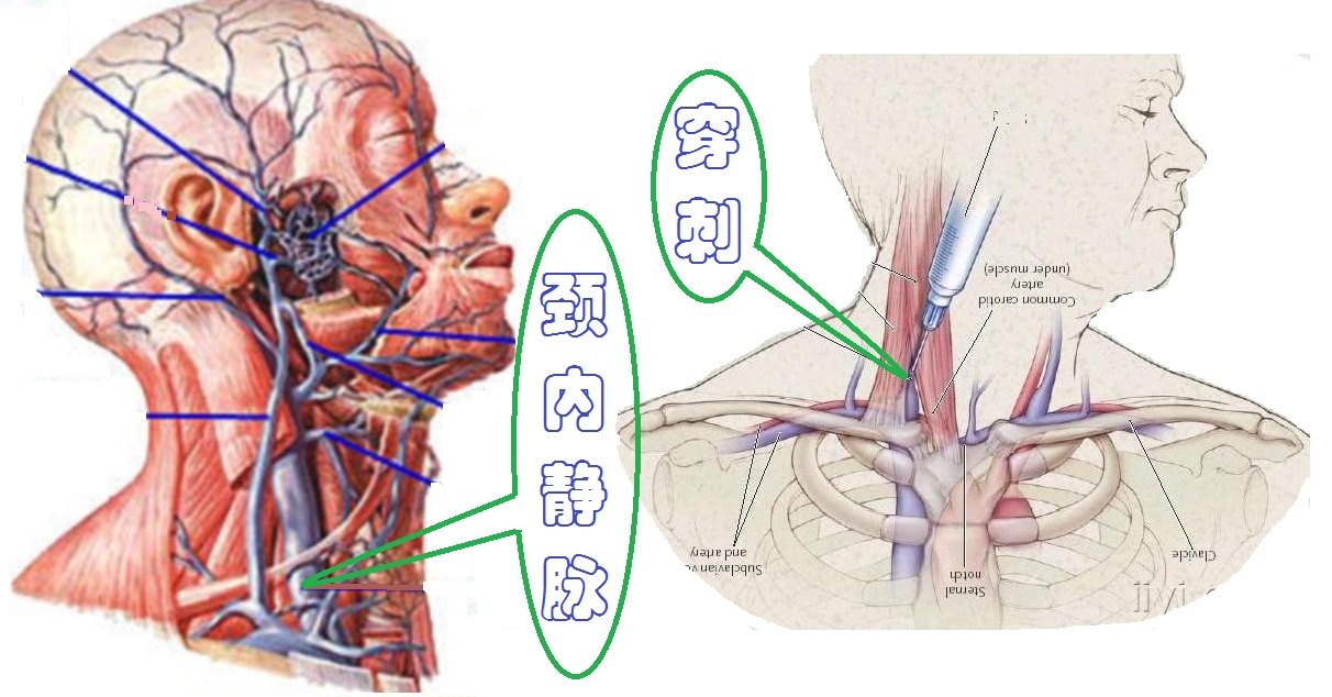 颈内静脉穿刺置管术ppt图片