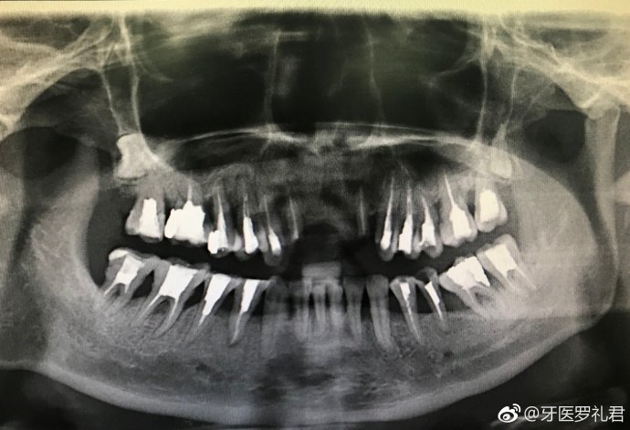 什么情况下需要根管治疗?