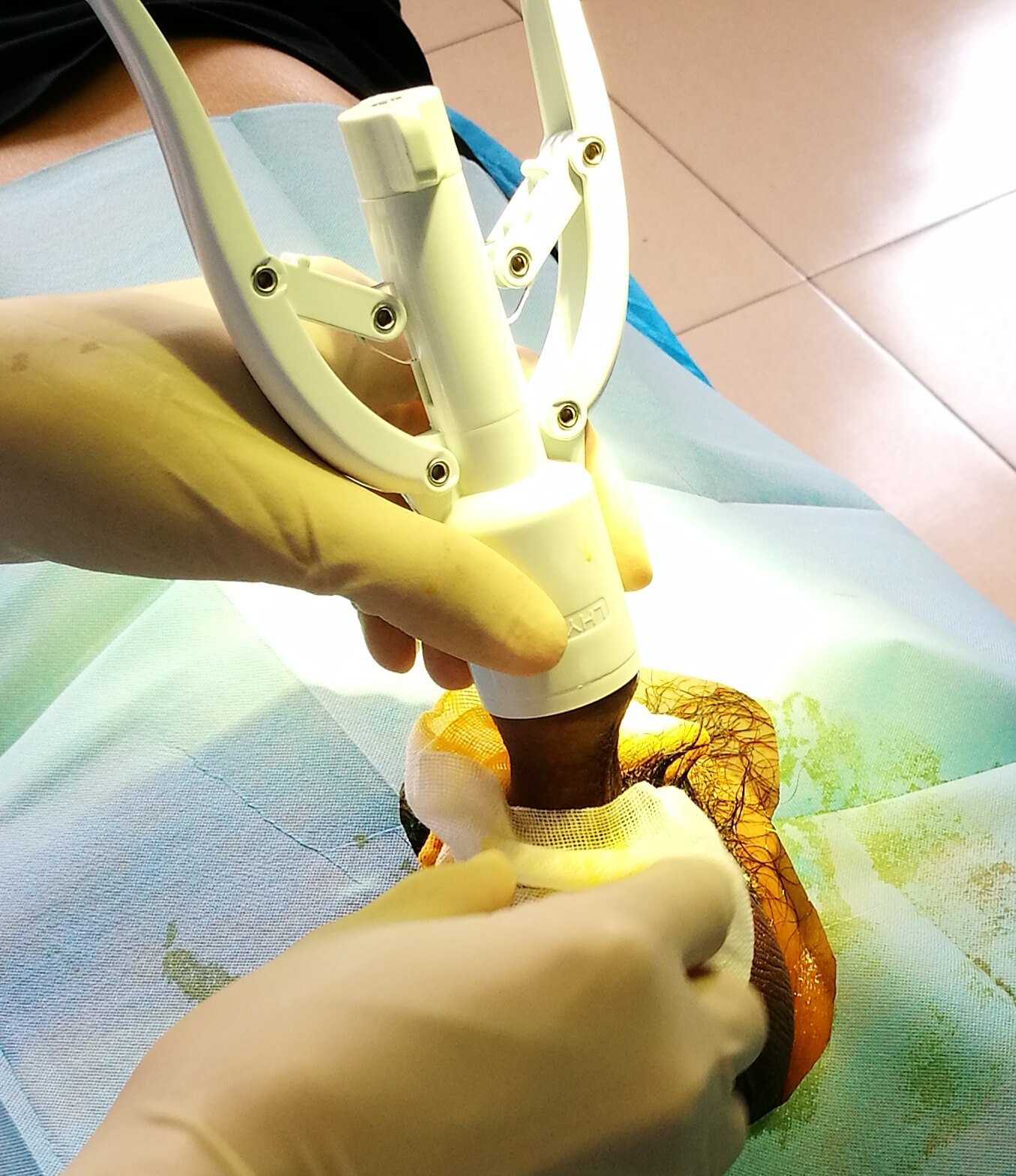 吻合器环切手术恢复图图片
