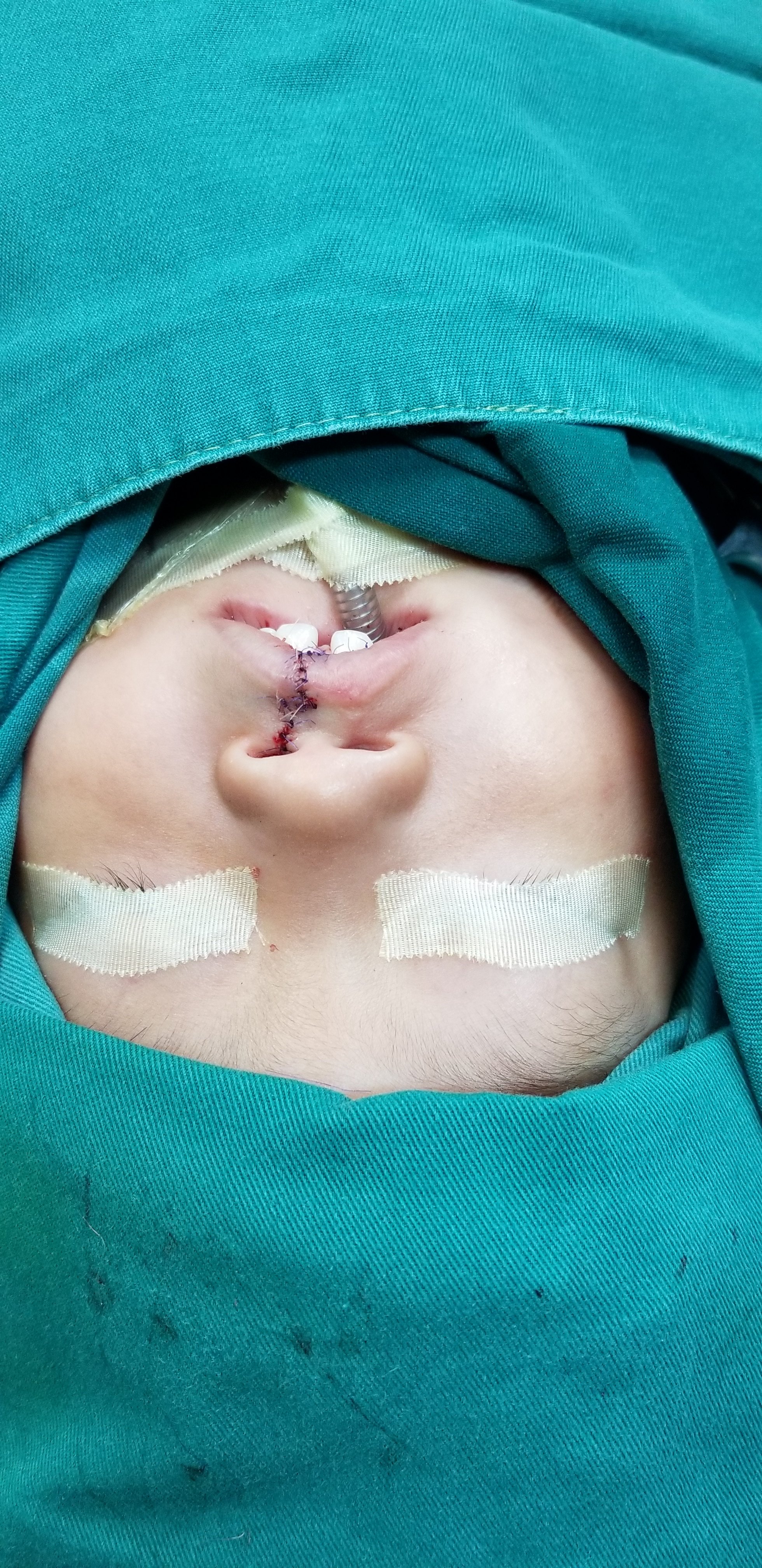 唇裂二次修复手术图片图片