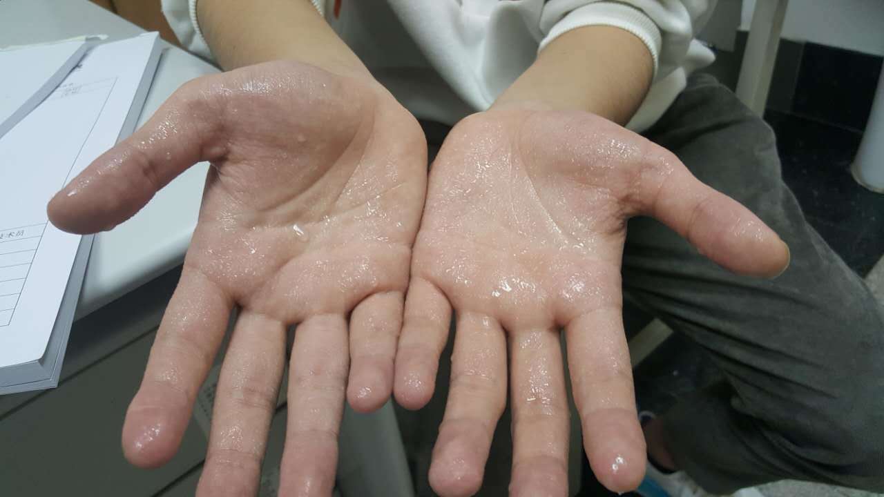 广东省人民医院胸外科张冬坤博士手汗症手术治疗患者的感谢信