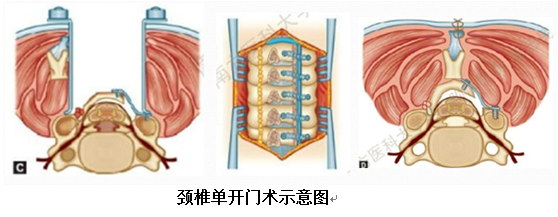 2,颈椎单开门术1,颈椎双开门术手术方式:检查方法:ct检查能够清晰显示