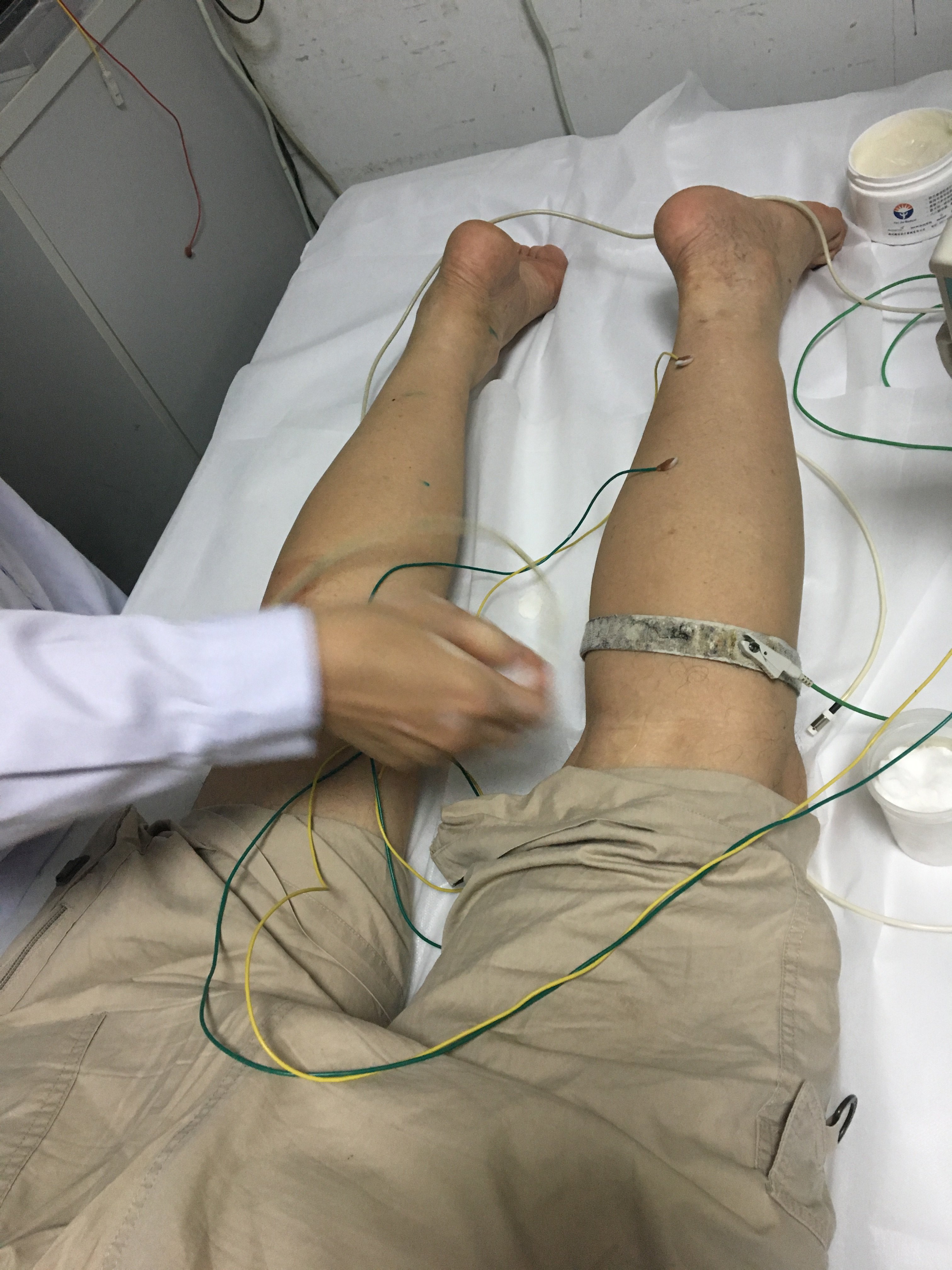 2例初步诊断为运动神经元病的老年患者的启示 - 好大夫在线