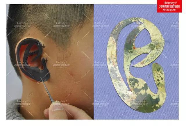 按照健康耳朵轮廓结构1:1精雕成耳朵模样,再埋植入耳后,造出耳廓外形