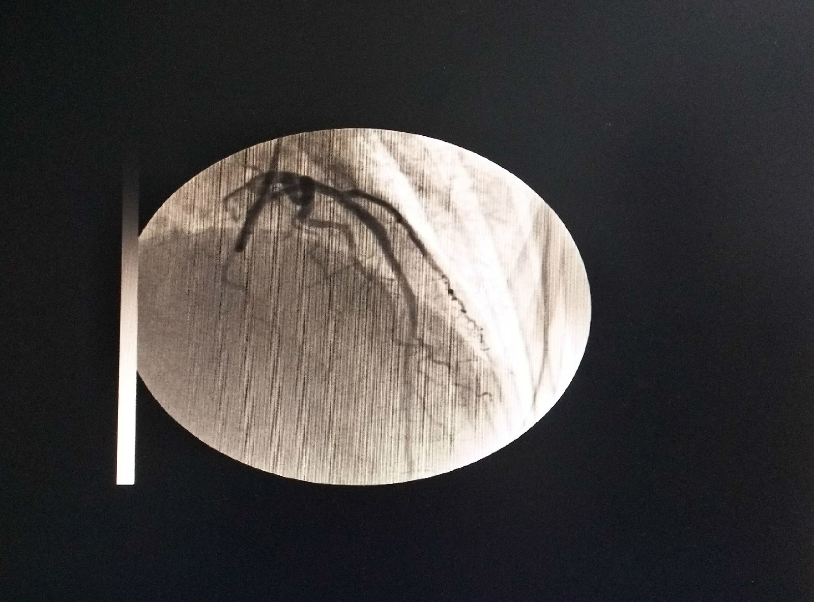 前降支近端支架植入一例