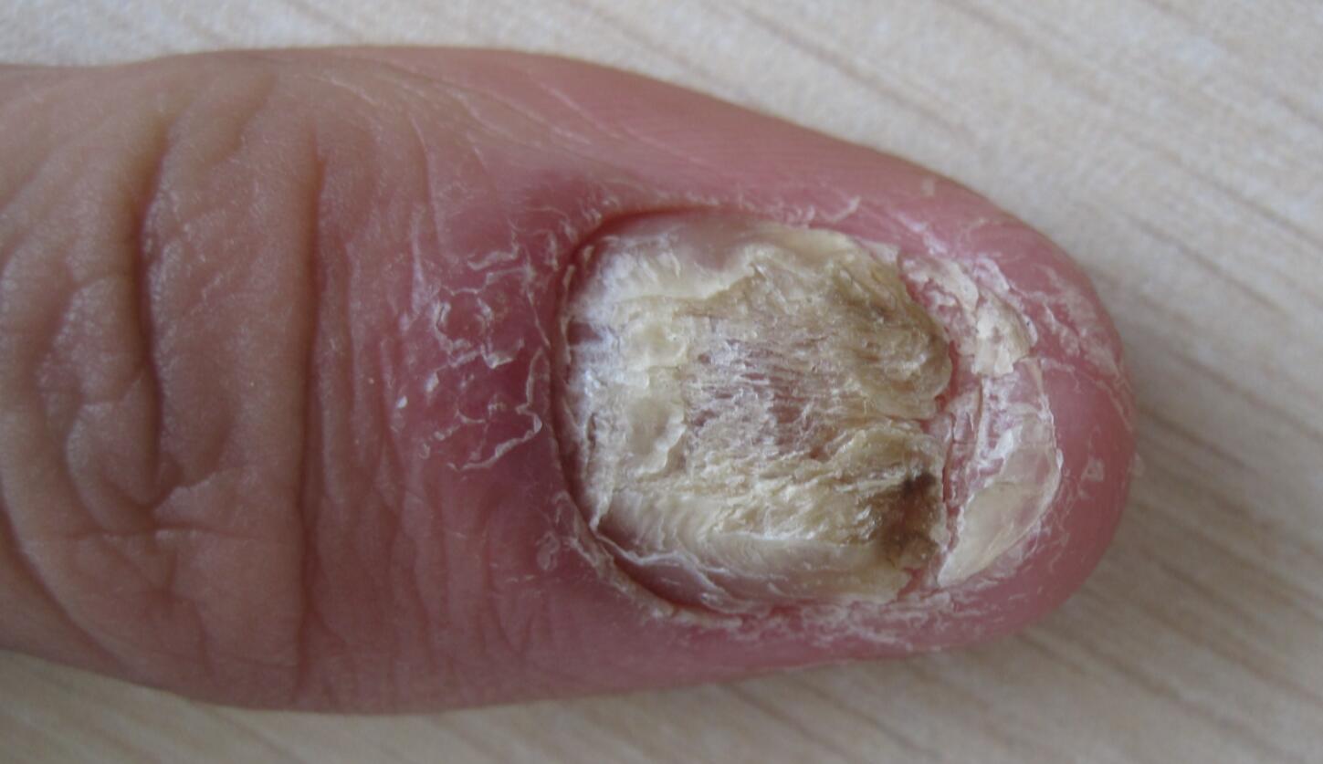 脚指甲银屑病图片图片
