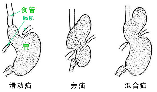 經臍單切口腹腔鏡手術治療小兒食管裂孔疝