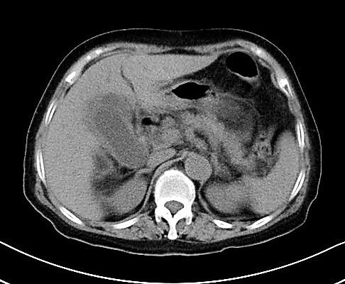 刘荣芝-ct-急性梗阻性化脓性胆囊炎胆囊颈部结石.jpg