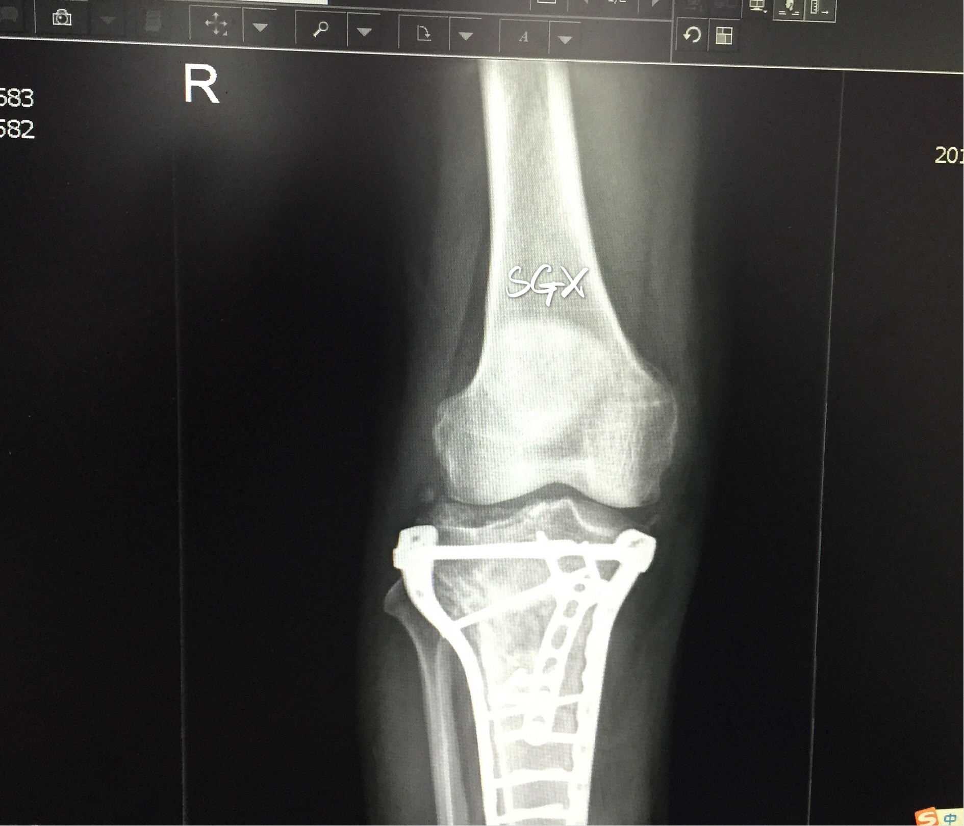 骨折后钢板要取吗 什么情况下取钢板 骨折后钢板要取吗 什么情况下取钢板