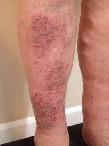 下肢静脉曲张的严重危害