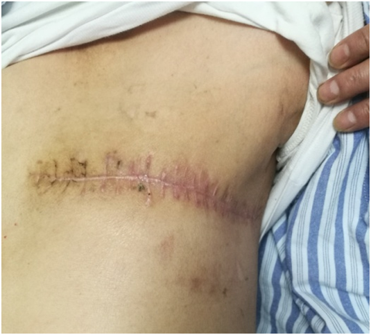 不讲科学,吃亏的总是自己,再一例溃烂菜花状乳腺癌的治疗 - 好大夫