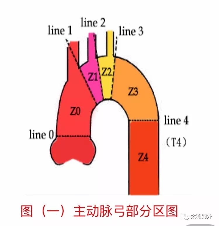 主动脉示意图图片