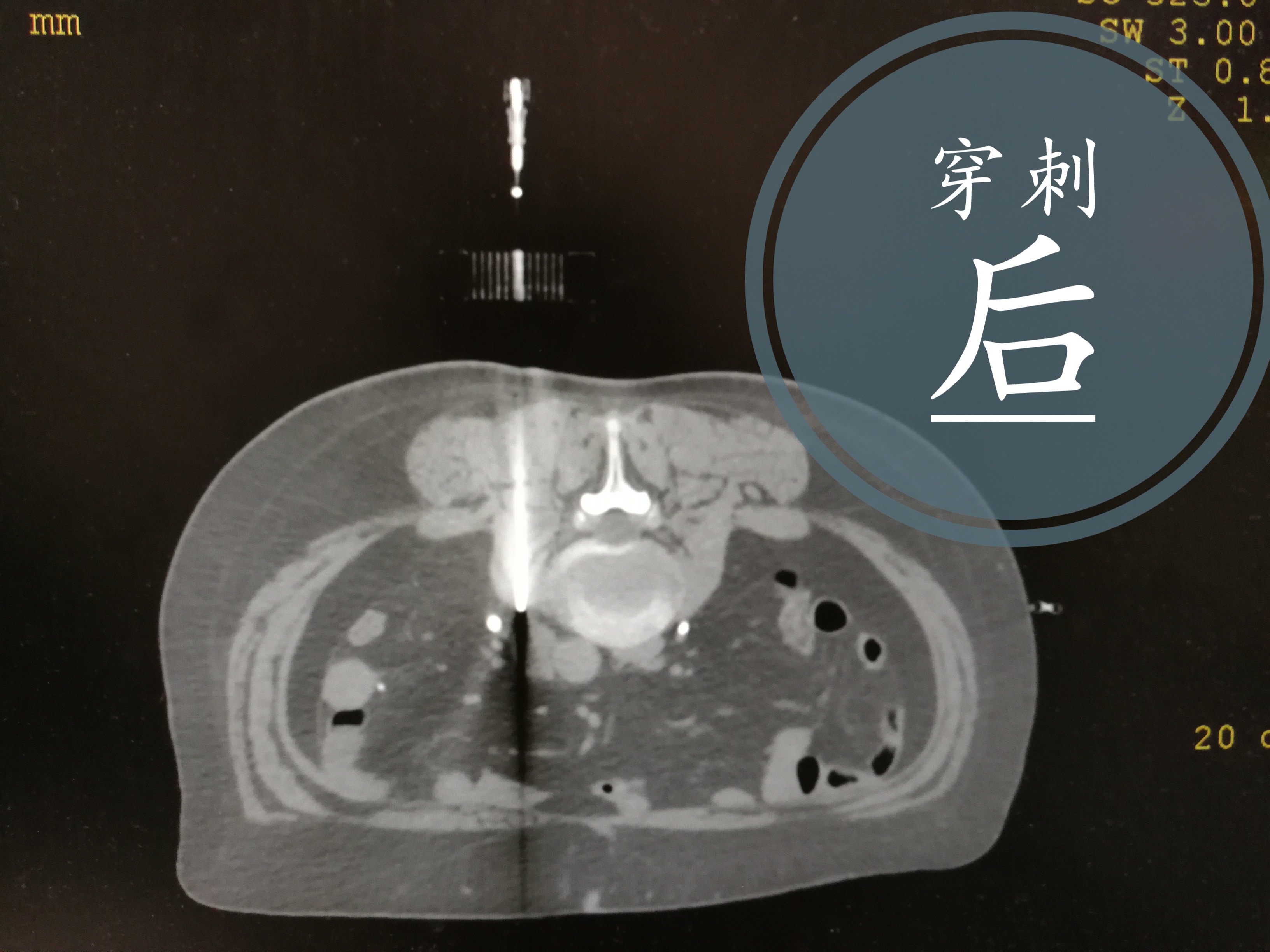 淋巴结穿刺针的图片图片