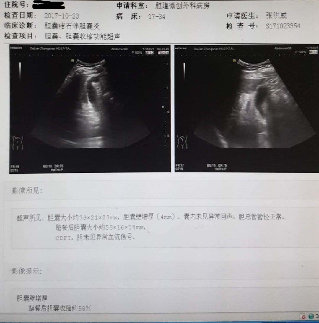 一例充满型胆囊结石保胆取石治疗成功的案例