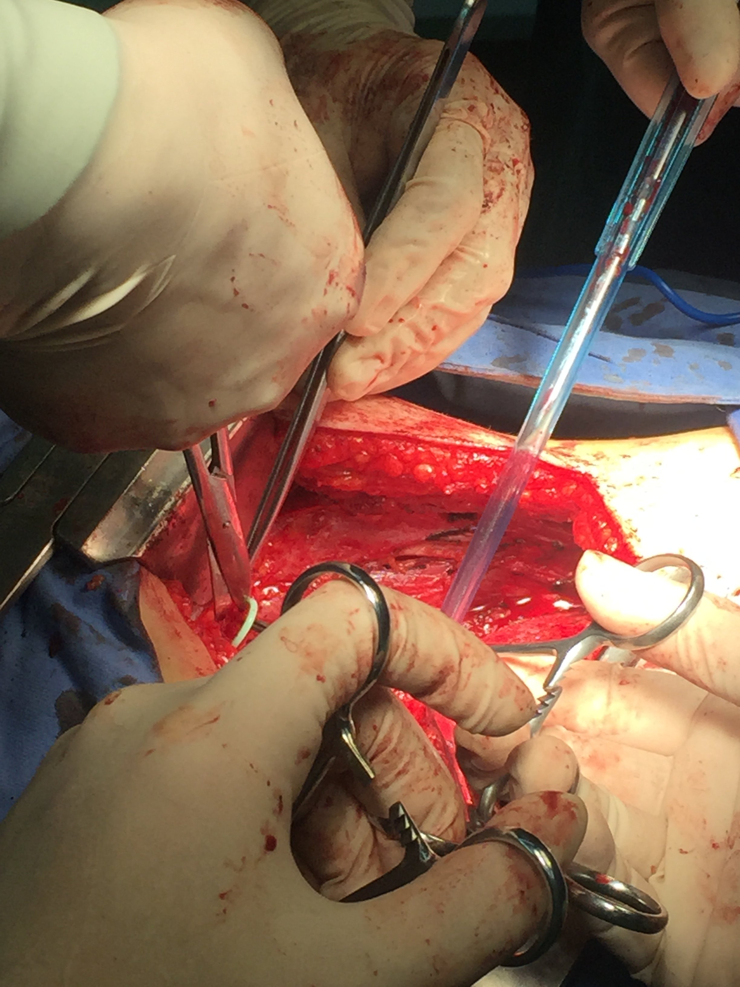 输尿管上段损伤修复3