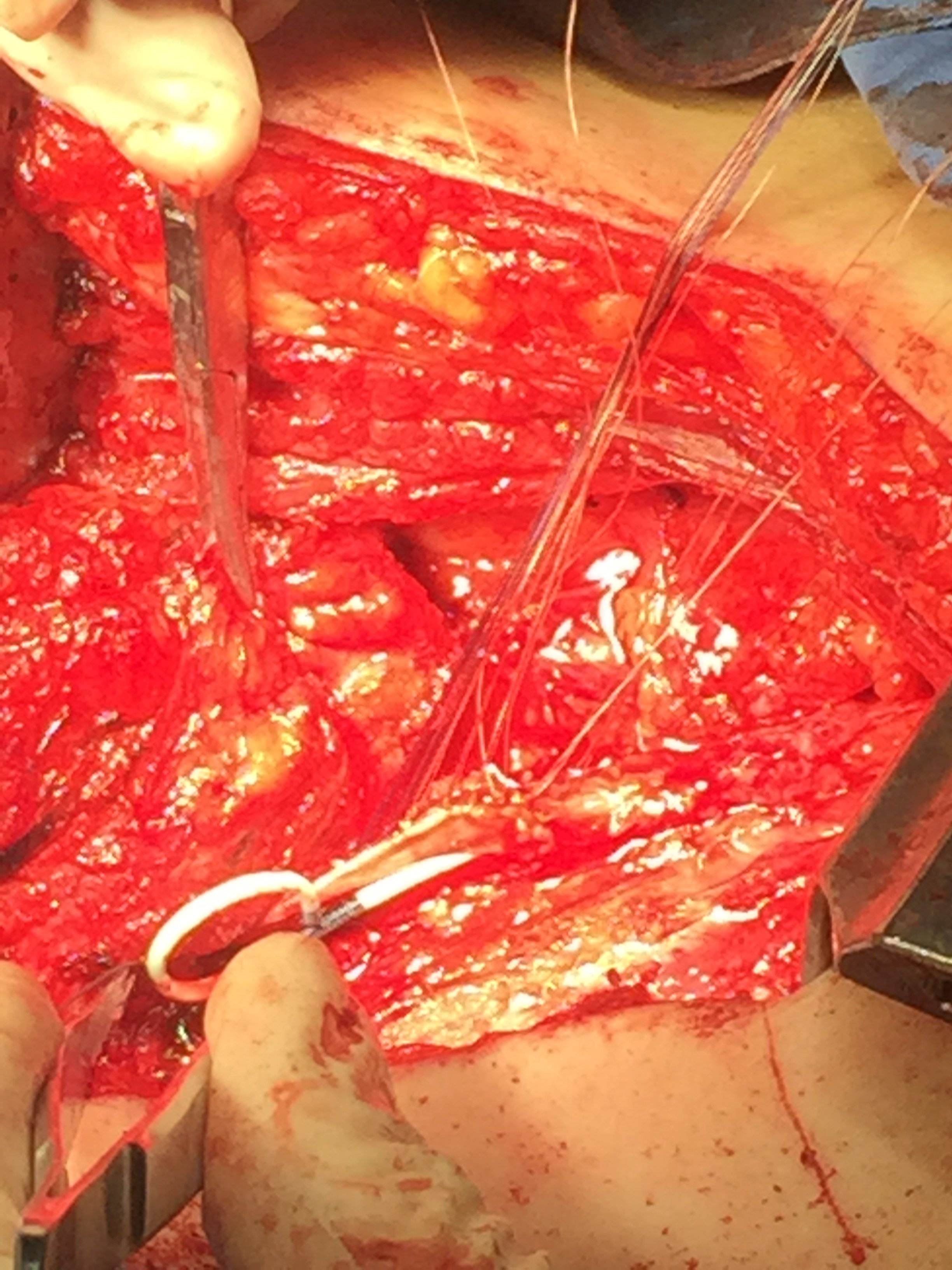 输尿管上段损伤修复3-----开放肾盂瓣成形术 - 好大夫在线