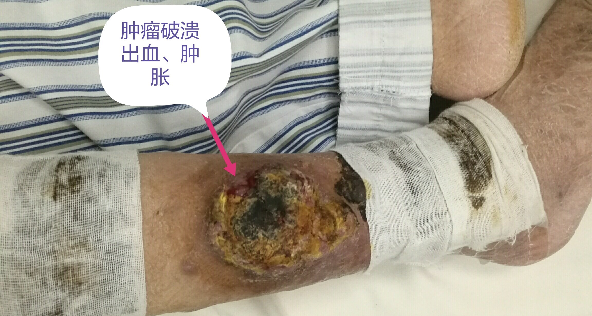 腿上长恶性肿瘤的图片图片